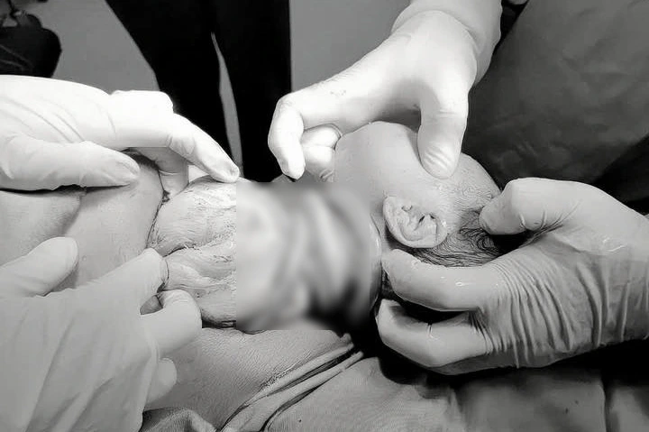 Bé gái chào đời với 6 vòng dây rốn quấn cổ (Ảnh: BVCC)