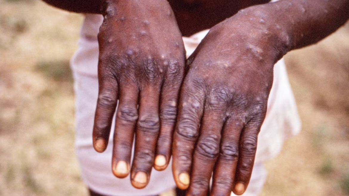 monkeypox-body1.jpg