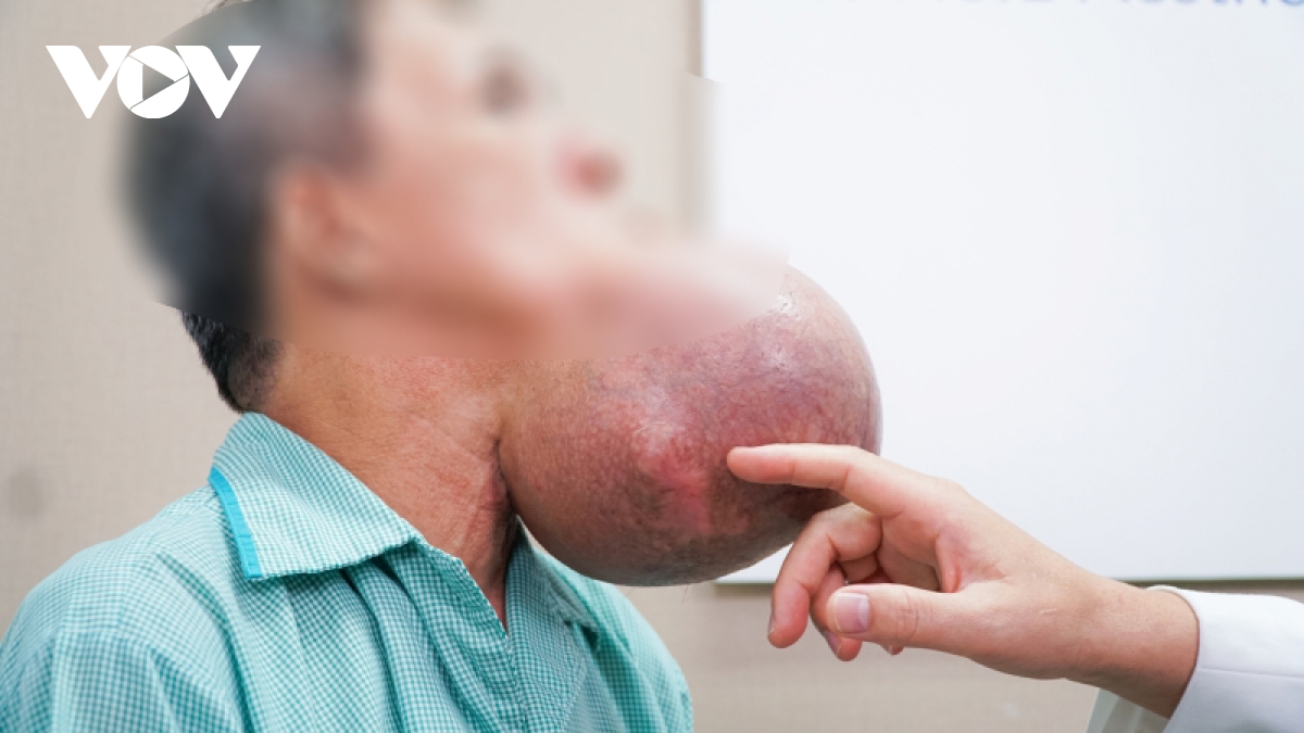 6 gio cang thang mo khoi u khong lo o cam cua nguoi lai xe om hinh anh 1