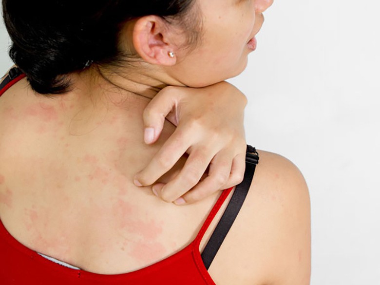 neu co mot trong nhung trieu chung nay ban can di kham lupus ngay hinh 4