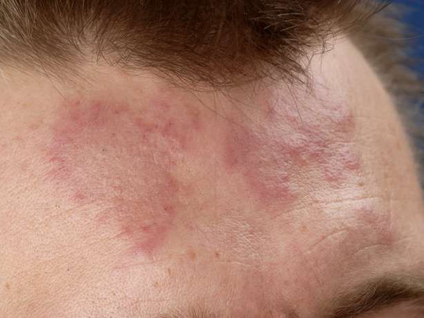 10 trieu chung cua benh lupus ban do  hinh 5