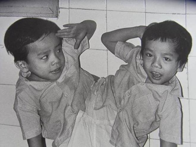 cac cap song sinh dinh lien phau thuat thanh cong tai viet nam hinh 1