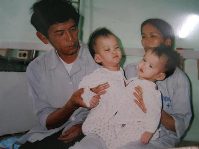cac cap song sinh dinh lien phau thuat thanh cong tai viet nam hinh 2