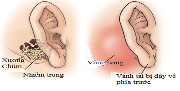 thoi tai - trieu chung cua nhieu benh ly nguy hiem hinh 4