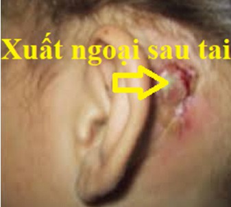 thoi tai - trieu chung cua nhieu benh ly nguy hiem hinh 3
