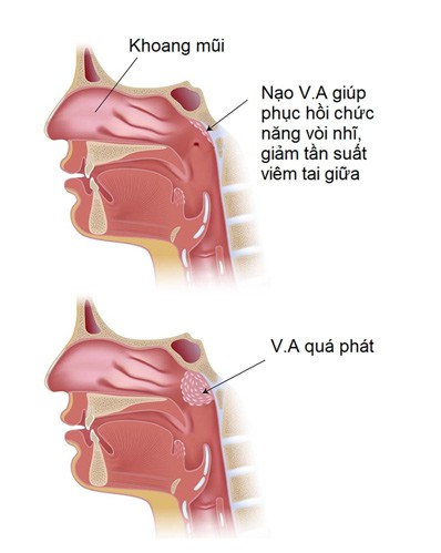 dieu tri viem tai giua tai dien o tre hinh 2