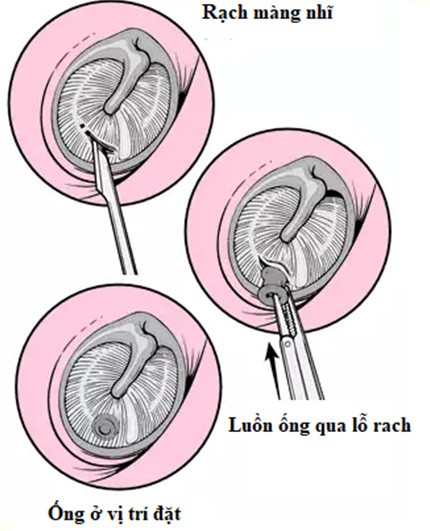 dat ong thong khi khi viem tai giua lau ngay hinh 2