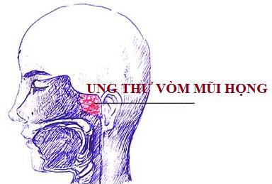 phat hien som ung thu vom mui hong hinh 2
