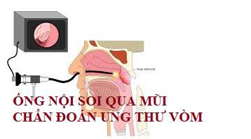 phat hien som ung thu vom mui hong hinh 3