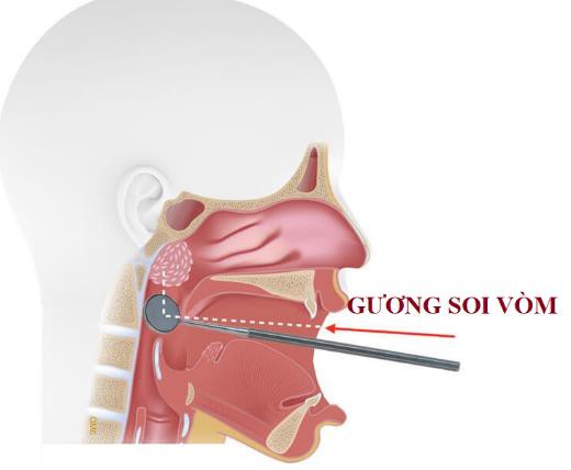 phat hien som ung thu vom mui hong hinh 4
