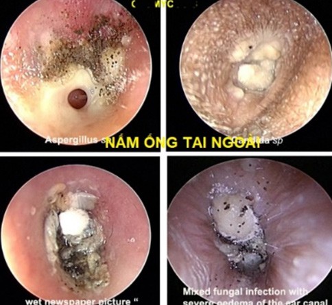 nam ong tai ngoai gay ngua tai chay dich hinh 2