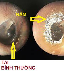 nam ong tai ngoai gay ngua tai chay dich hinh 1