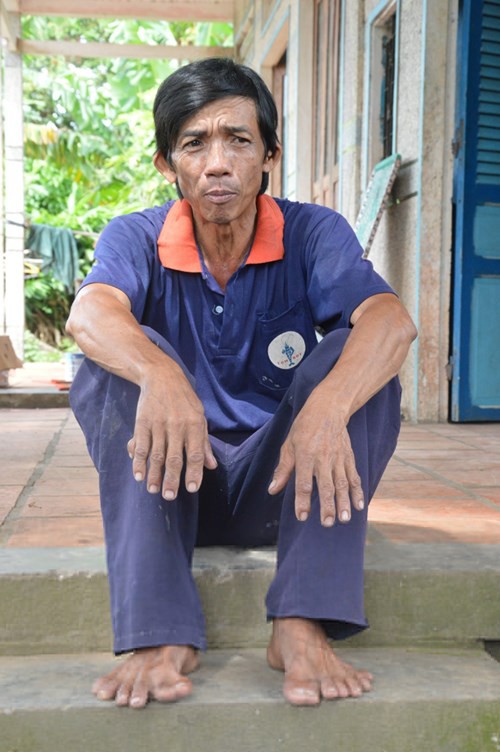  Ông Hảo, người sở hữu 25 ngón tay, chân. 