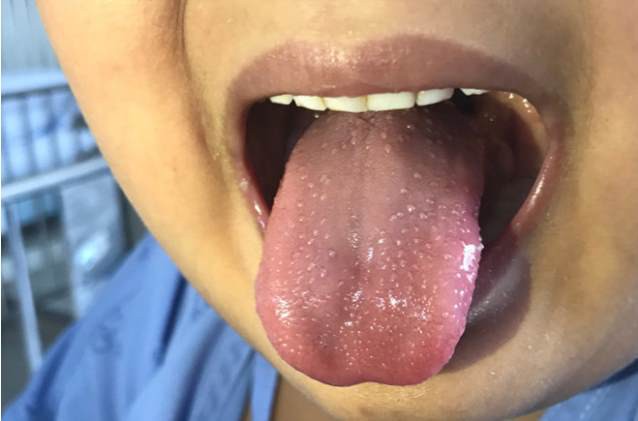 my xac nhan 38 tre em mac hoi chung viem hiem gap nghi do virus sars-cov-2  hinh 1