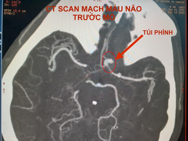 cap cuu thanh cong mot truong hop tui phinh dong mach nao bi vo hinh 2