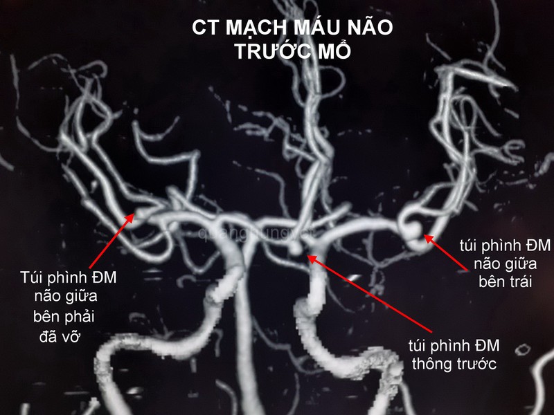 cuu song benh nhan da tui phinh mach mau nao bi vo hinh 1