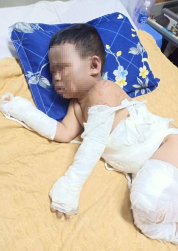 vu nem bom xang khien 2 be bi bong nang: khoi to vu an hinh 1