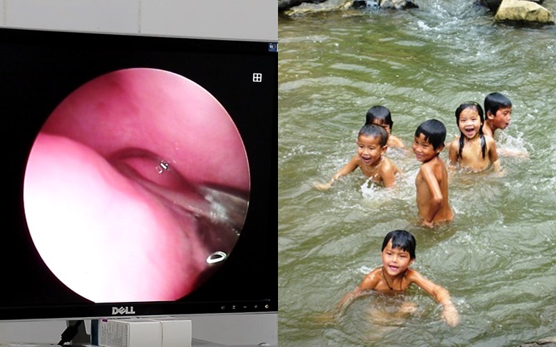 di tam thac, nu sinh bi dia dai 3cm chui vao mui hinh 1